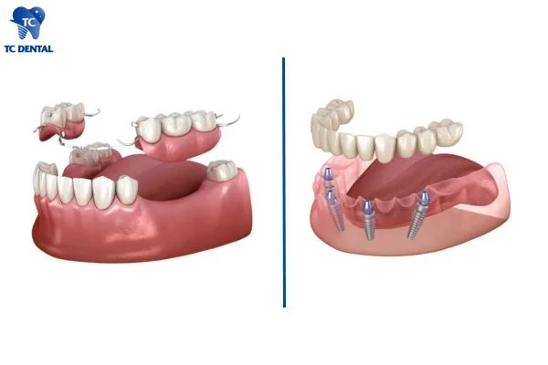 Răng giả tháo lắp với răng giả cố định implant