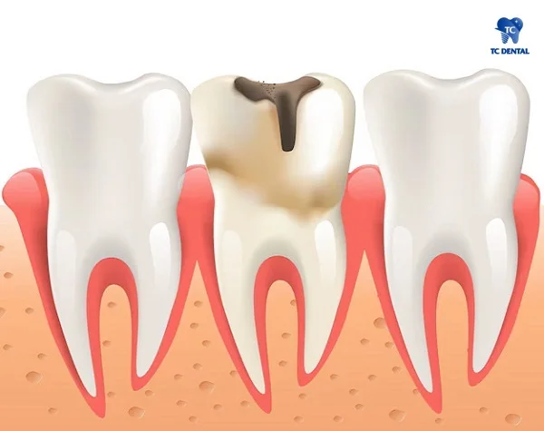 Răng sâu gây tổn thương đến tủy răng