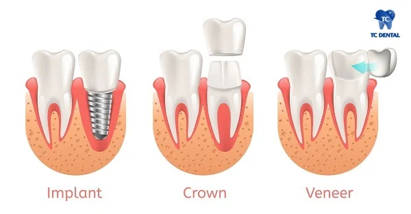 Các trường hợp bọc răng sứ cho răng sâu
