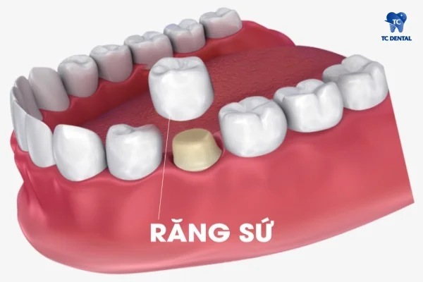 Gắn mão răng sứ