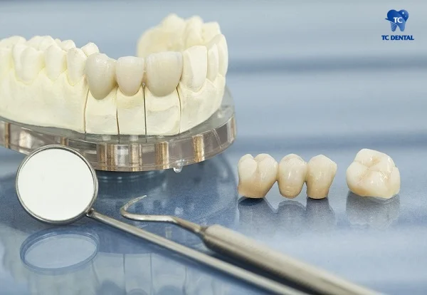 Chọn loại răng sứ phù hợp