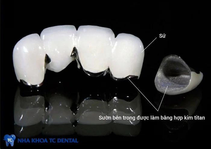 Răng sứ kim loại có thể xuất hiện viền đen ở nướu do lớp kim loại bên trong