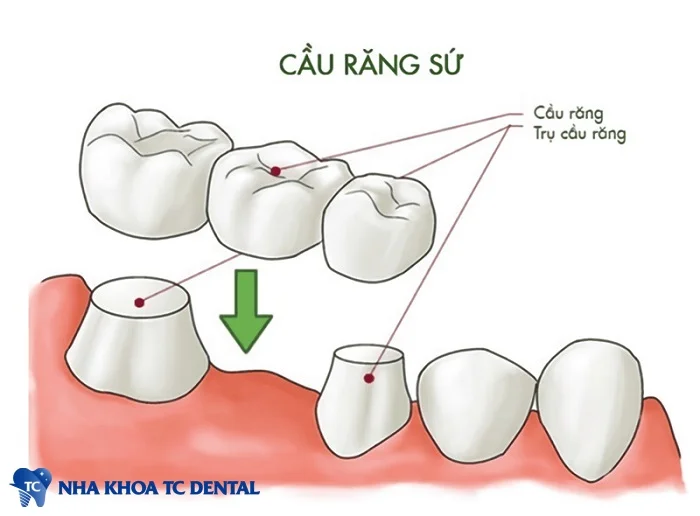 Mô hình cầu răng sứ