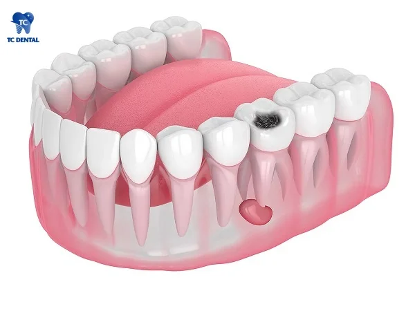 Răng sứ bị sâu răng, đau nhức