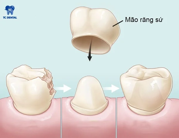 Quy trình bọc răng sứ lần 2