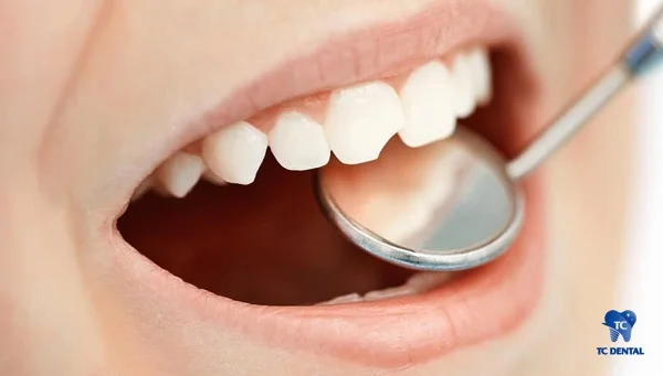 Trường hợp răng bị sứt mẻ