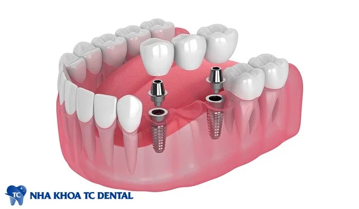 Cầu răng sứ trên trụ implant