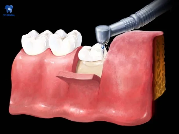 Nhổ răng khôn gây tổn thương cho các mô xung quanh