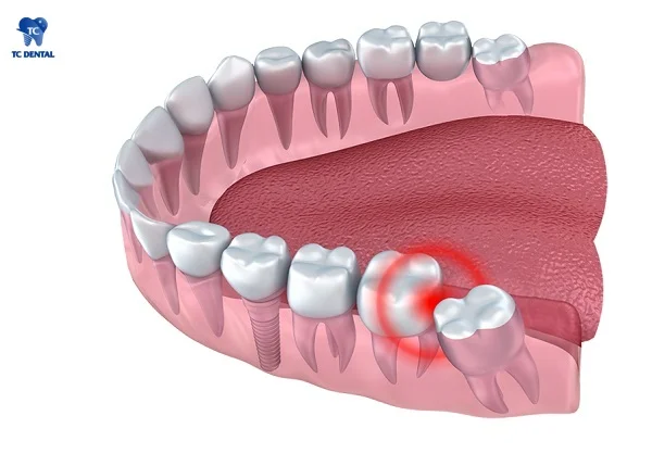 Răng khôn phức tạp gây khó khăn trong việc nhổ răng
