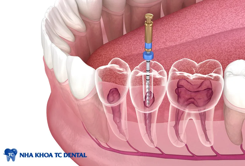 Điều trị tủy răng là một quy trình nha khoa nhằm loại bỏ mô tủy bị tổn thương hoặc nhiễm trùng trong răng