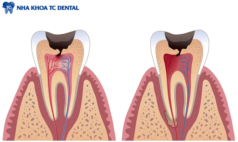 Điều trị tủy những răng bị sâu ăn vào tủy