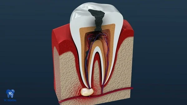 Răng sâu gây viêm, áp xe chân răng cần lấy tủy
