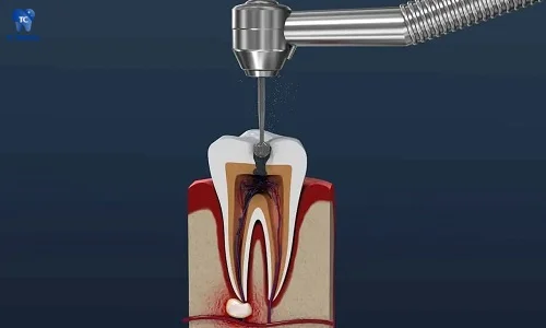 Lấy tủy răng đau không