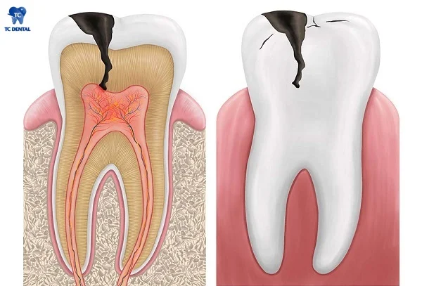 Tủy răng bị viêm nhiễm do sâu răng nghiêm trọng