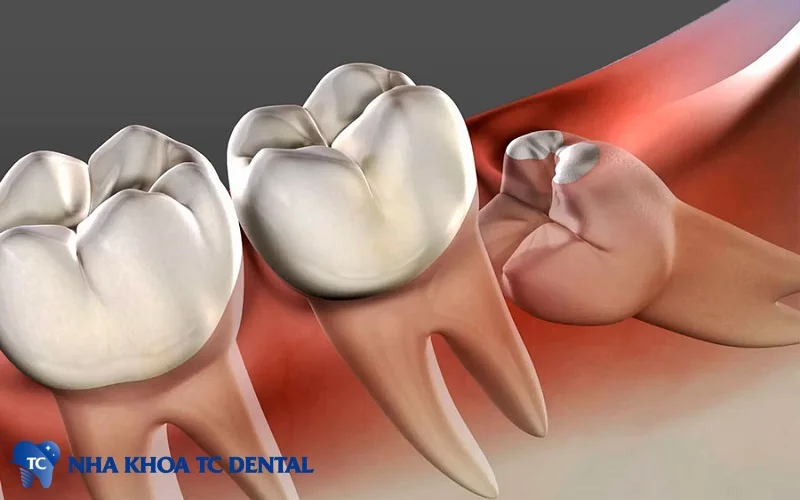 Răng khôn mọc lệch, răng khôn mọc ngầm cần được nhổ bỏ