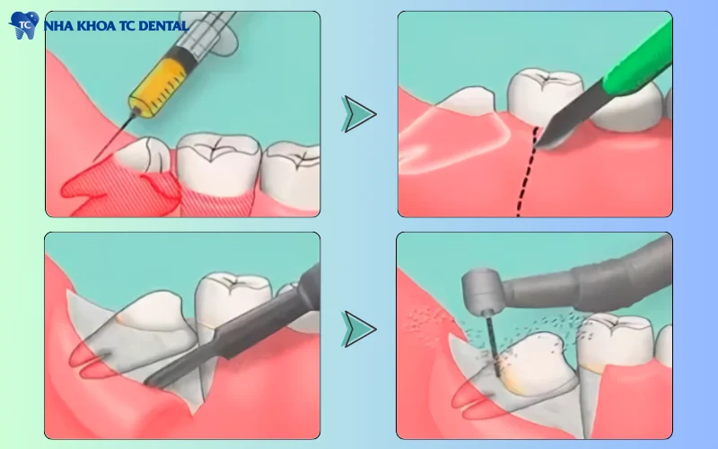 Răng khôn mọc lệch, răng khôn mọc ngầm cần được nhổ bỏ