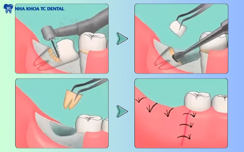 Bác sĩ thực hiện các thao tác rạch nướu, cắt nhỏ răng để nhổ răng khôn mọc lệch