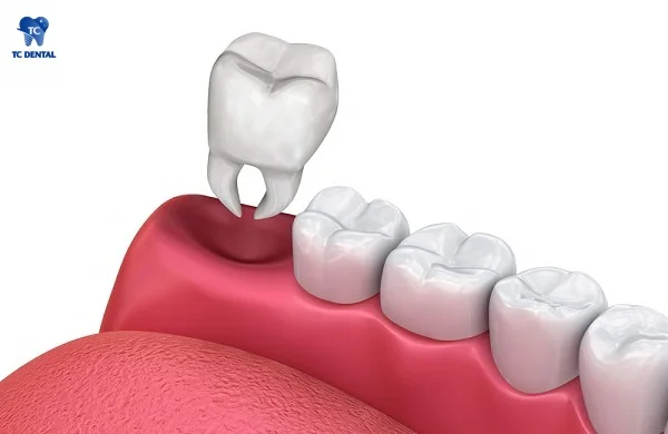 Nhổ răng khôn bằng máy giúp giảm đau