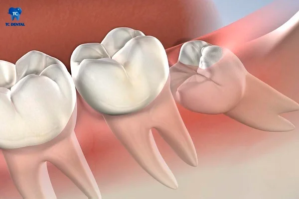 Trường hợp răng khôn mọc lệch