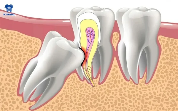 Răng khôn mọc ngầm, mọc lệch gây tổn thương răng bên cạnh