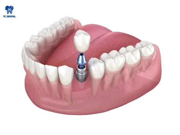 Phương pháp cấy ghép implant