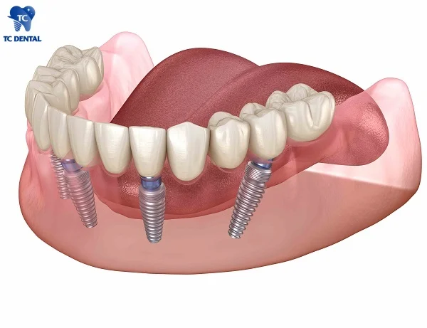 Răng giả tháo lắp trên trụ Implant