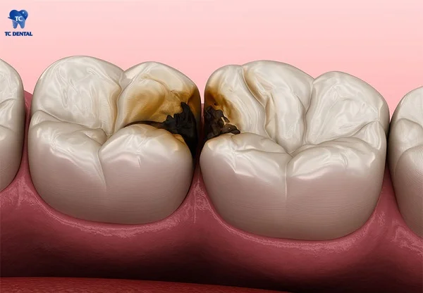 Sâu răng số 7 và răng bên cạnh
