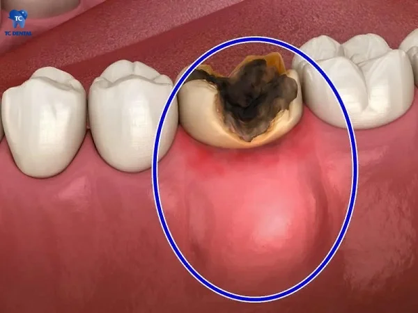 Răng sâu quá nặng dẫn đến viêm tủy và áp xe răng
