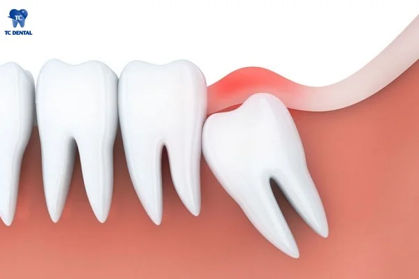 Răng khôn mọc lệch, chèn ép răng số 7