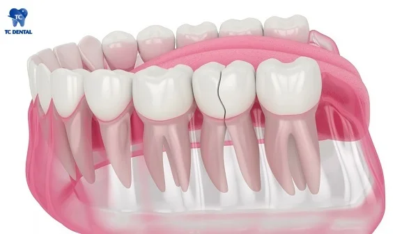 Răng số 7 bị nứt gãy