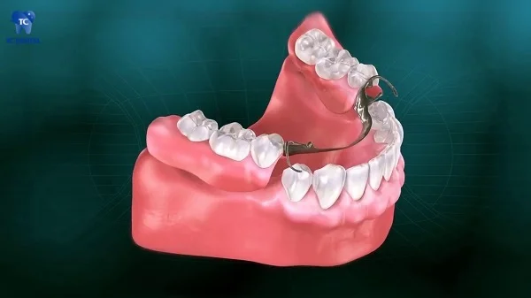 Trồng răng giả tháo lắp