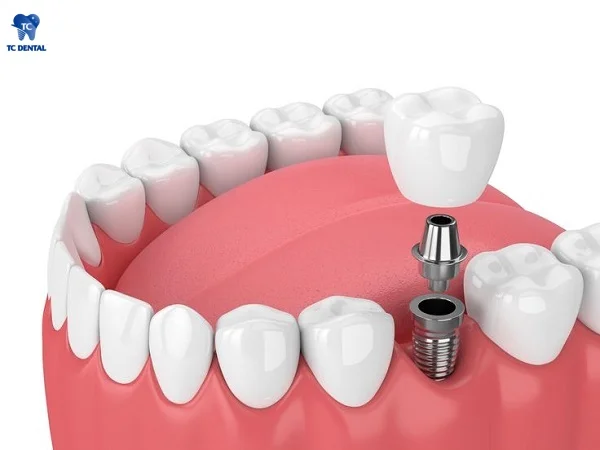 Cấy ghép implant răng số 7