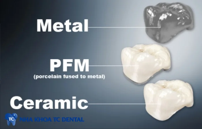 Răng sứ kim loại bao gồm một lớp hợp kim bên trong và một lớp sứ bên ngoài