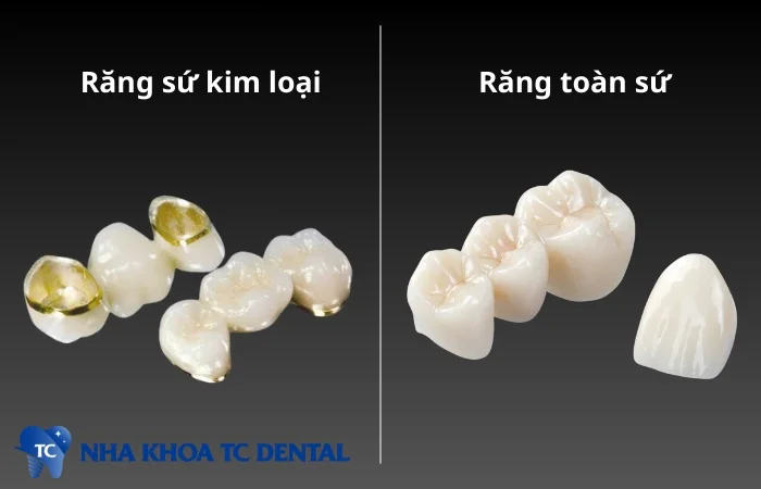 Răng sứ kim loại và răng toàn sứ là hai loại vật liệu nha khoa phổ biến được sử dụng trong bọc răng sứ thẩm mỹ