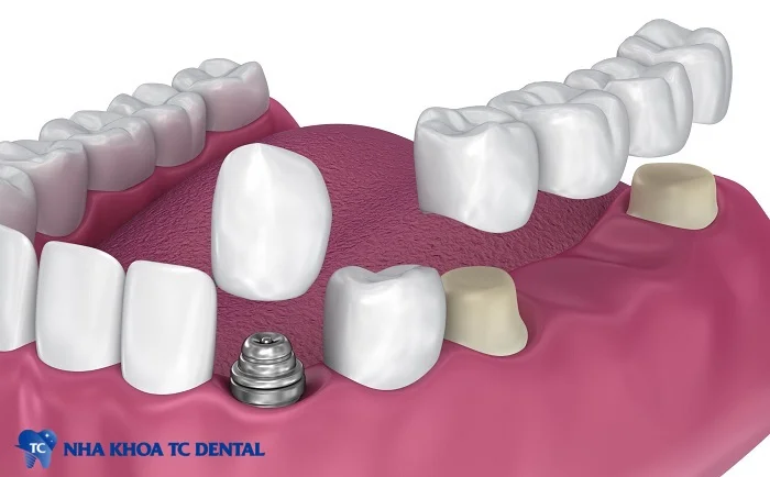 Răng sứ Bleach Zirconia được ứng dụng trong phục hình nguyên khối, mão và cầu răng, cấy ghép implant