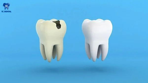 Men răng yếu hoặc mỏng dễ gây sâu răng