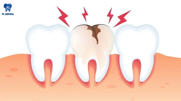 Sâu răng gây viêm tủy và nhiễm trùng