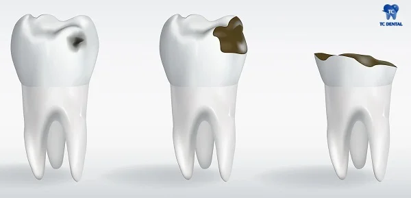 Sâu răng không được điều trị khiến răng hỏng hoàn toàn