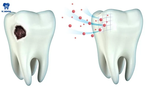 Phương pháp điều trị sâu răng