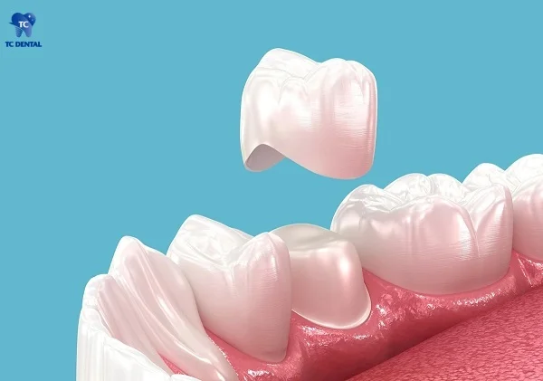 Bọc răng sứ răng sâu