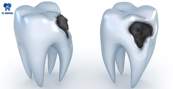 Sâu bề mặt răng