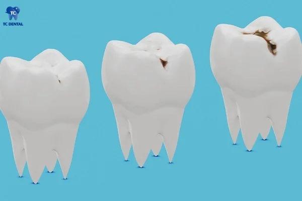 Các giai đoạn phát triển của sâu răng