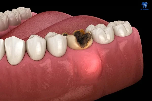 Áp xe hình thành ở chân răng sâu