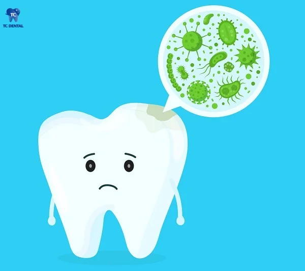 Vi khuẩn là thủ phạm chính gây sâu răng