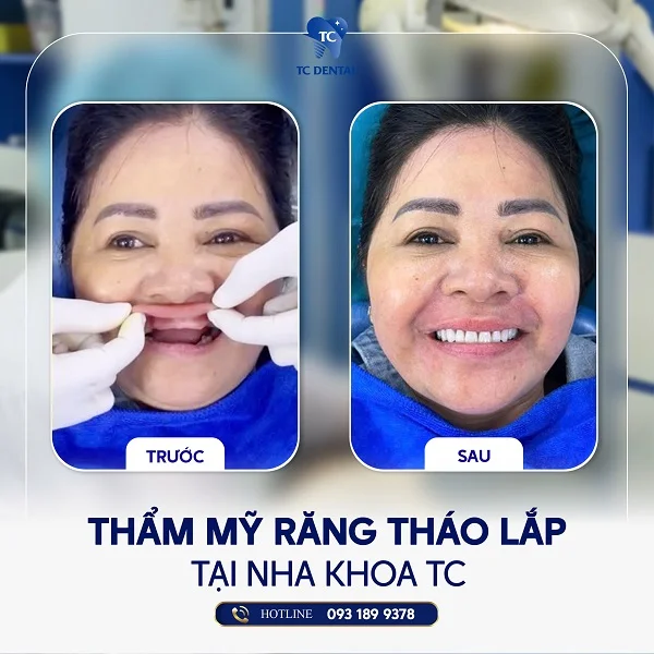 Răng hàm giả tháo lắp Hàn Quốc