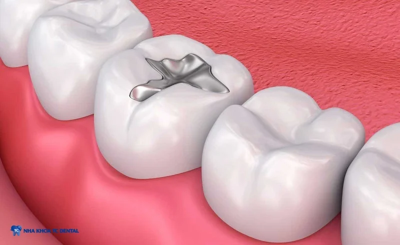 Trám răng bằng Amalgam có độ bền cao nhưng màu sắc không tương đồng với răng tự nhiên