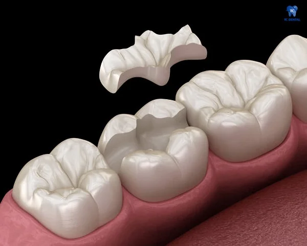 Trám răng inlay onlay giúp khô phục răng sâu