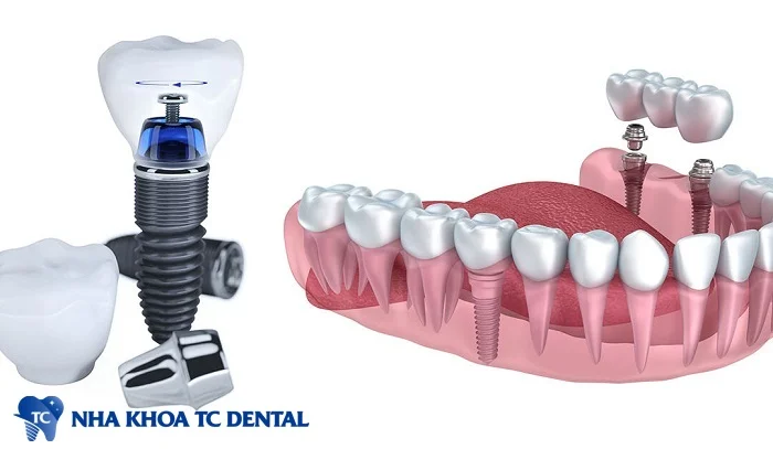 Trồng răng giả implant là phương pháp hiện đại và có độ bền cao