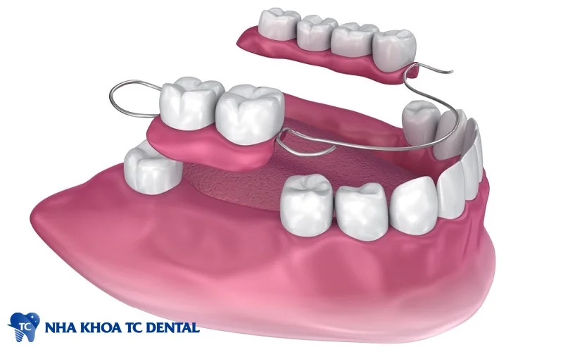 Quy trình trồng răng hàm giả tháo lắp đảm bảo chất lượng phù hợp với tình trạng của bệnh nhân