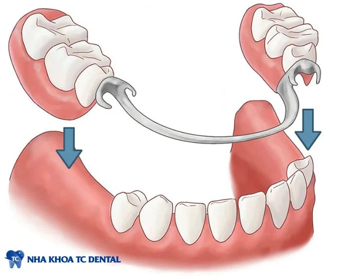 Răng hàm giả tháo lắp được thiết kế để người dùng có thể dễ dàng lắp vào và tháo ra khi cần